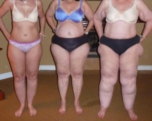 Lipoedema